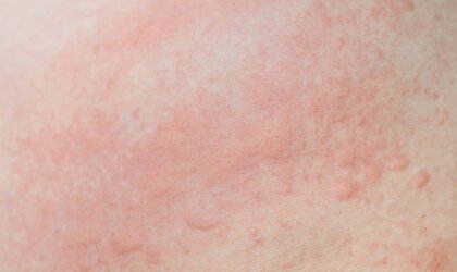 ผื่นลมพิษ skin rash urticaria คันผิวหนัง Allergic skin rash prickly heat skin red dot closeup skin problem itching