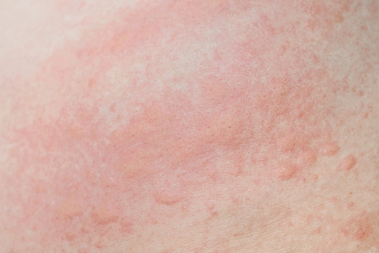 ผื่นลมพิษ skin rash urticaria คันผิวหนัง Allergic skin rash prickly heat skin red dot closeup skin problem itching