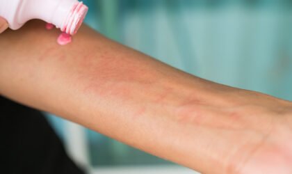 Urticaria on hand woman non-lethal type from food and air poisoning. she apply Calamine Lotion medicine on the arm her.she Sick, have an allergic reaction. Urticaria on skin body.healthcare concept.