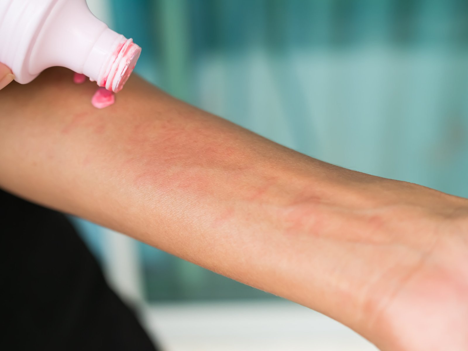 Urticaria on hand woman non-lethal type from food and air poisoning. she apply Calamine Lotion medicine on the arm her.she Sick, have an allergic reaction. Urticaria on skin body.healthcare concept.